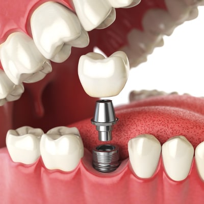 diş implantı nasıl yapılır