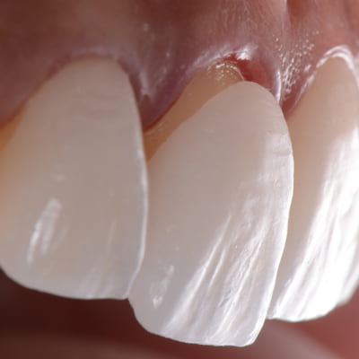 diş kaplama nasıl yapılır