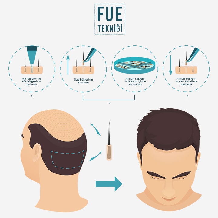 FUE saç ekimi nasıl yapılır