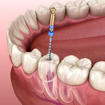 diş kanal tedavisi nasıl yapılır