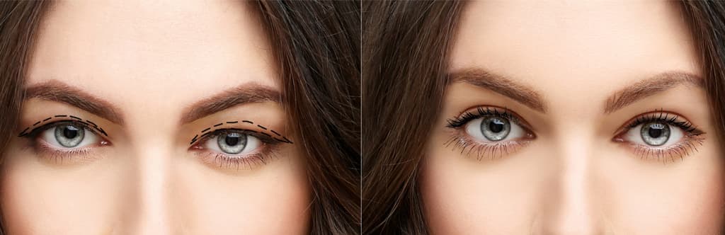 How is an Eyelid Aesthetic procedure Blepharoplasty performed?