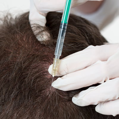 Hair Mesotherapy