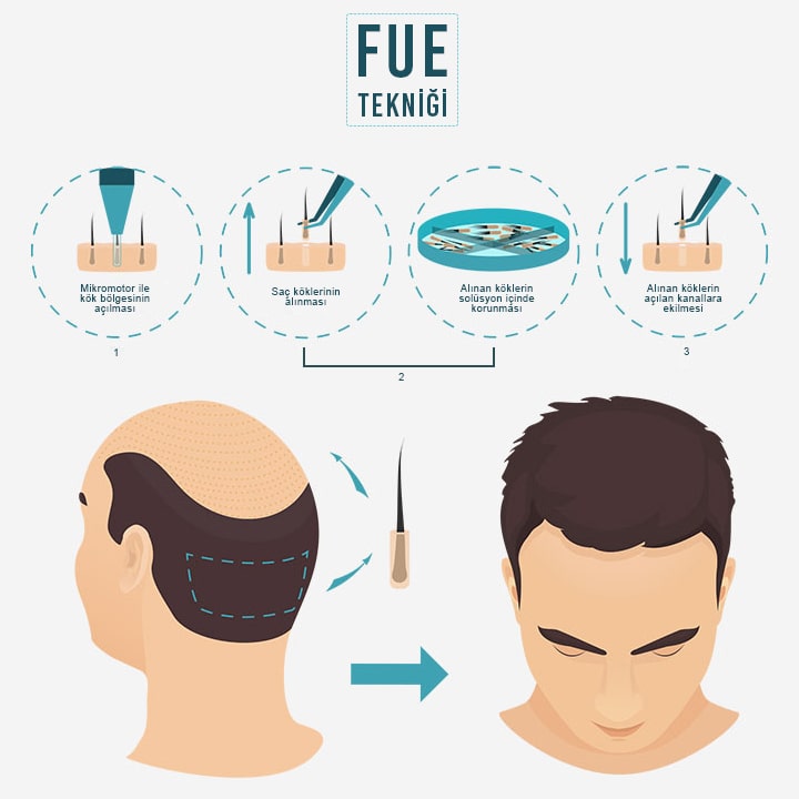 Fue Hair Transplant in Turkey