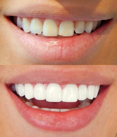 Hollywood smile cost in Turkey