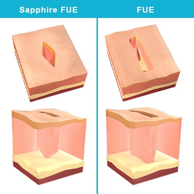 How Is A Sapphire FUE Hair Transplant Operation Performed