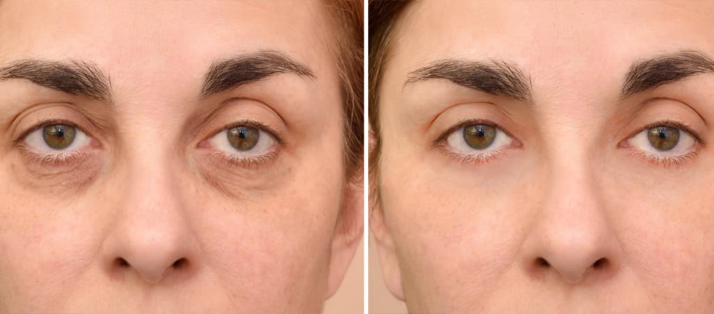 Under eye light filler cost